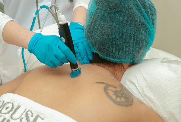 Détatouage laser à lyon : votre peau mérite une nouvelle chance